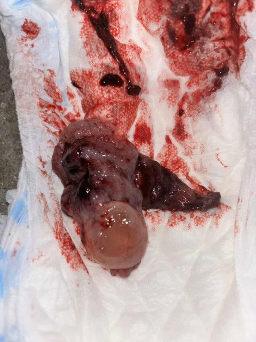 bligthed ovum 😭