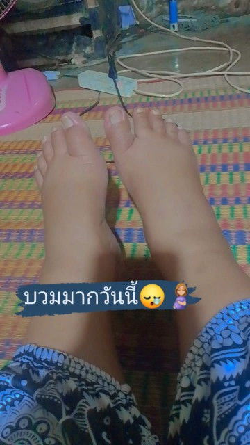 เท้าบวมมากคะ