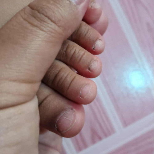 เล็บเท้าเป็นแบบนี้เพราะอะไร