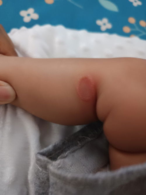 Cream apa yang cocok untuk luka di kulit
