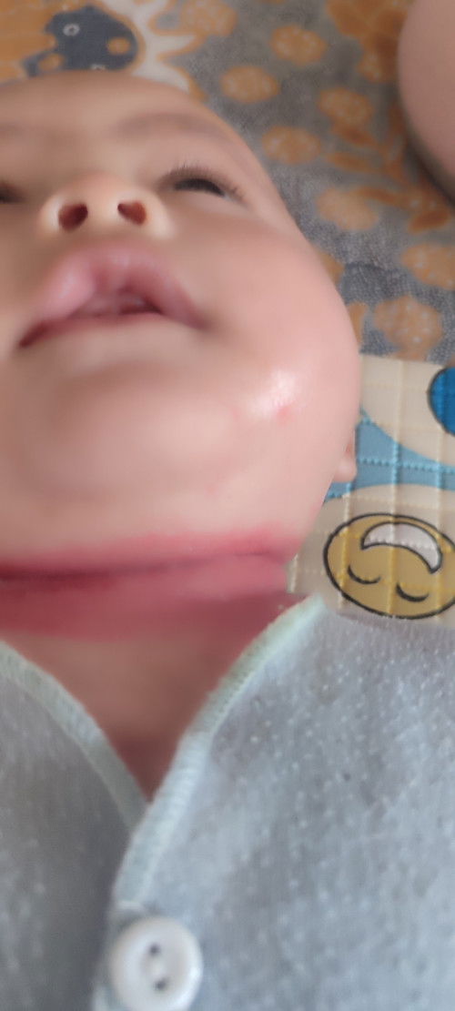 Kulit bayi keluar beruntusan merah