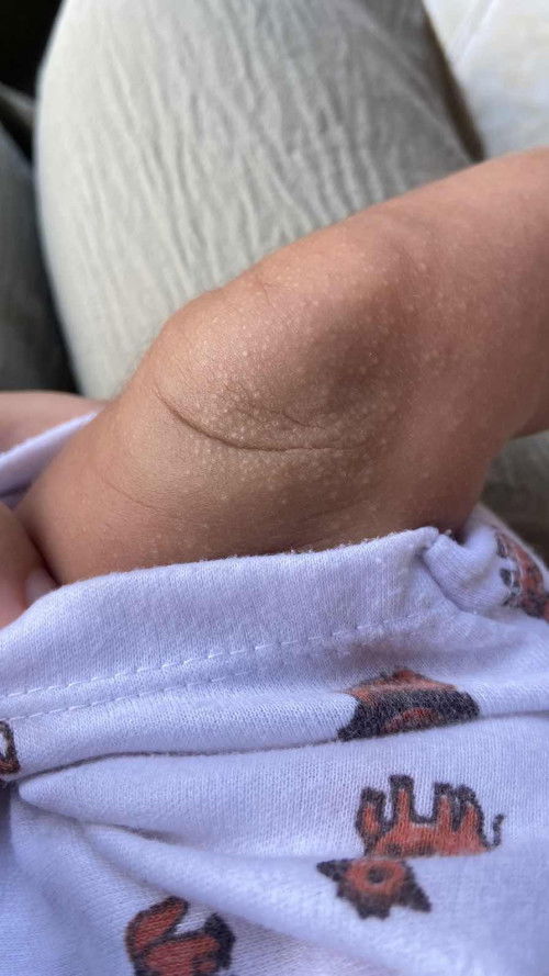 Bintik bintik pada bayi