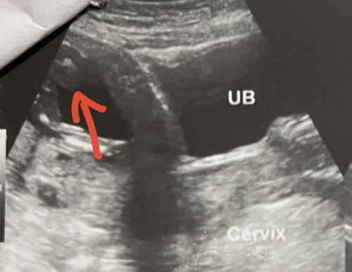 15 weeks and 6 day Ultrasound