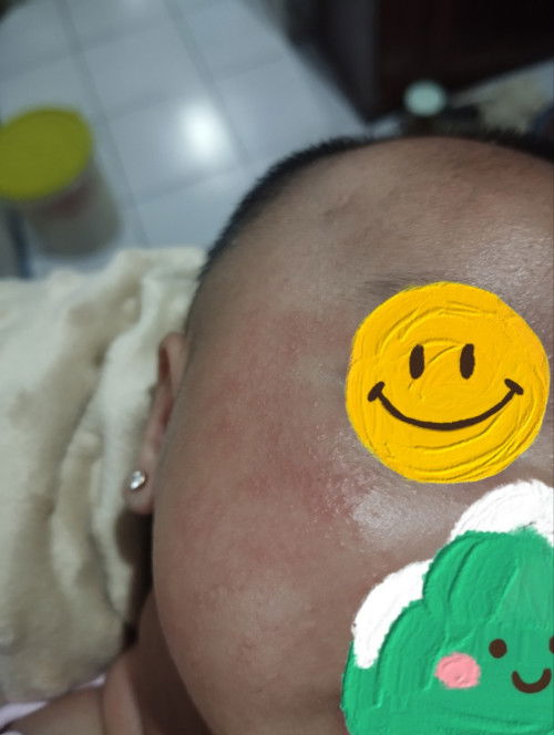 Bintik hitam ruam di wajah bayi 1 bulan