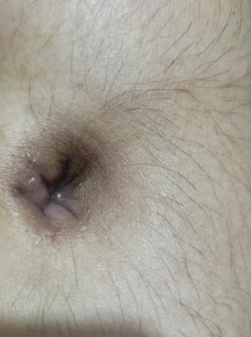 Watery Navel Discharge
