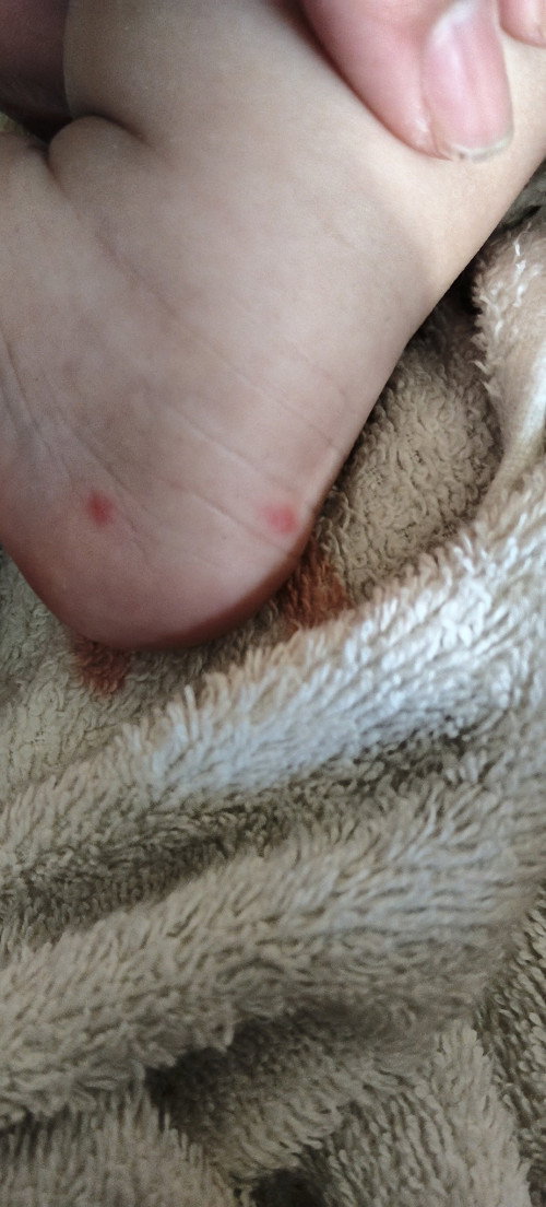 Bintik merah pada kulit bayi