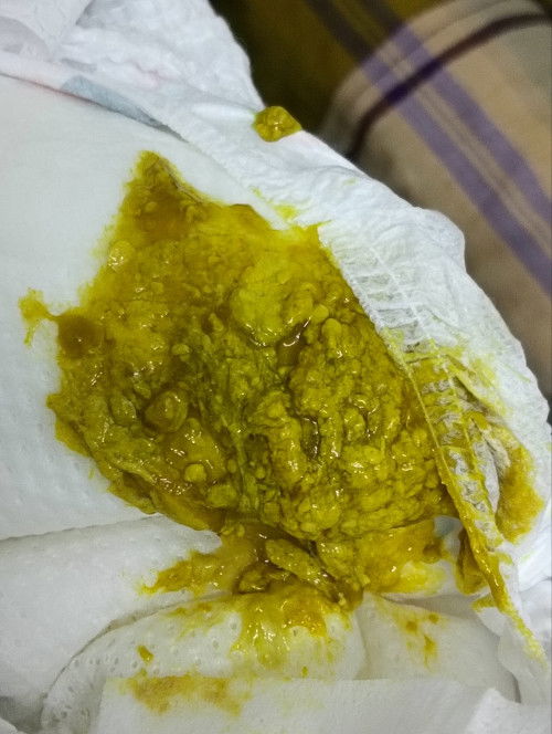 Adakah normal?