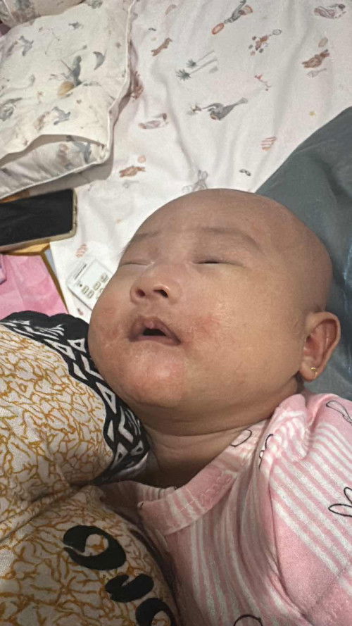 RUAM / BABY RASH
