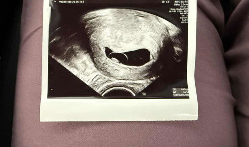 Missed miscarriage 9 weeks