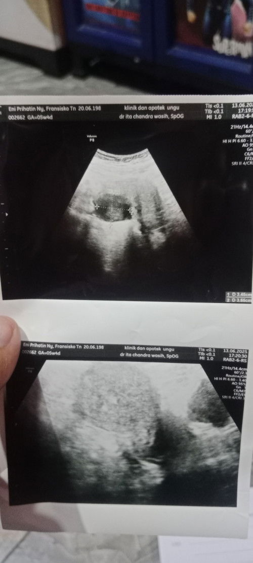 Sharing yuk bund Barangkali ada yg sama ini kehamilan ke4 anak ke3 hphtku 5 mei