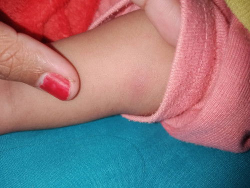 Kenapa ya tangan bayiku muncul bentolan seperti ini, itu tiba² pas bangun tdr, curiga sih digigit
