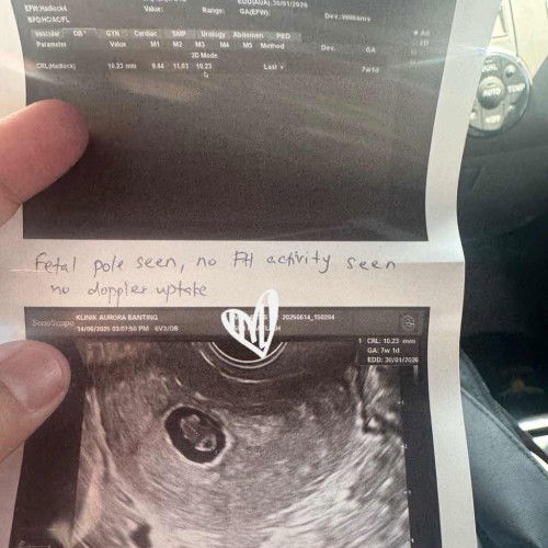 Tiada heartbeat 7week