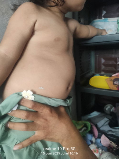 Perut anakku buncit