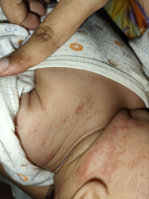Skin rashes 3mo old