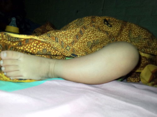 Kaki bayi 2 bulan seperti ini normal kah bun? 
Klo diliat rada bengkok gitu