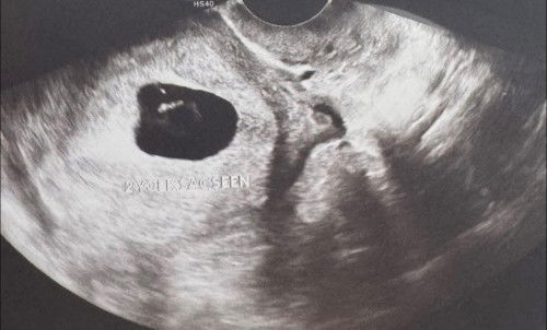 Scan baby 8 minggu