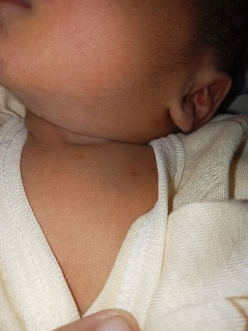Bintik di leher newborn