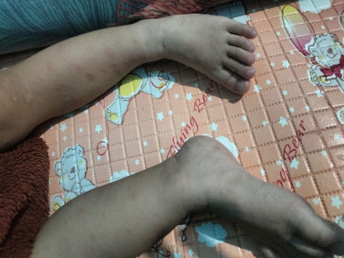 Hallo bunda sharing dong
Kalau bentol merah itu bisa hilang tapi muncul lagi kenapa ya bun?