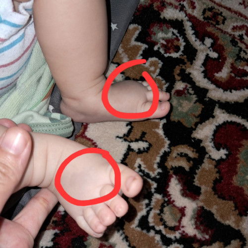 Kaki bengkak di tekan lembek