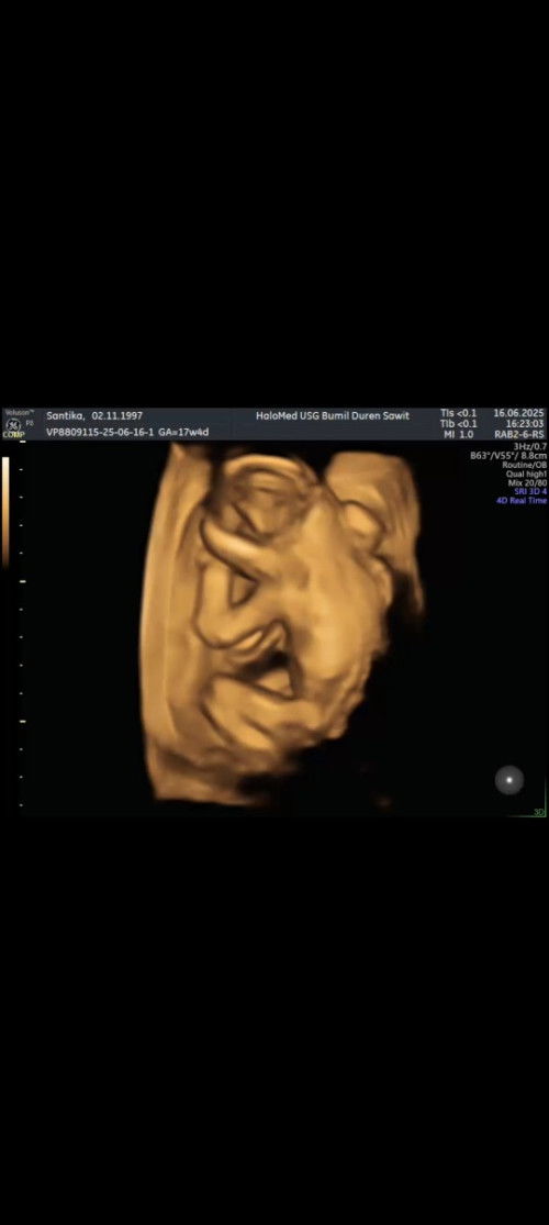 UK 17weeks sudah terlihat jk nya