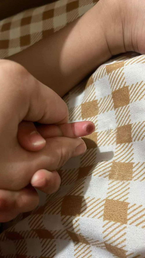 Paso sa daliri - dapat ko pa bang ipacheck up or nagheheal na to?