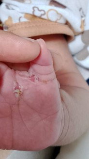 Telapak tangan luka