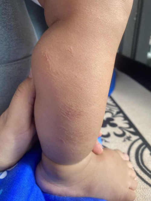 Kulit anak jadi macam ni..