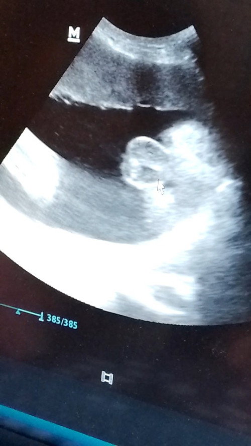 Hasil usg 37 weeks ini cewe atau cowo ya?