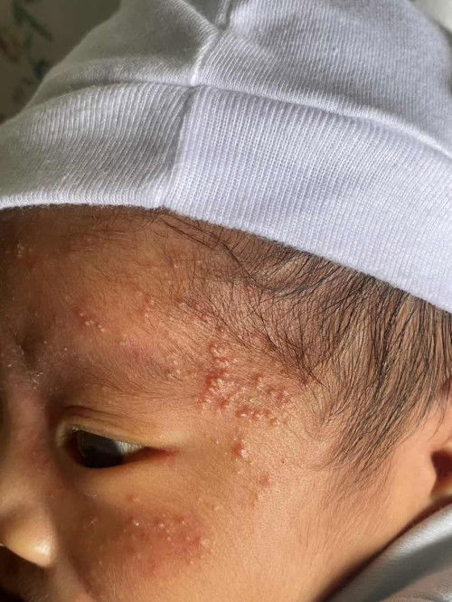 Severe newborn acne
