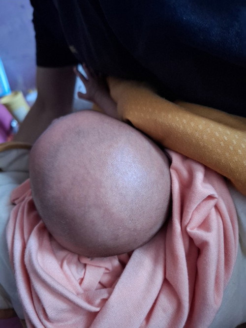 Bintik seperti jerawat dikepala