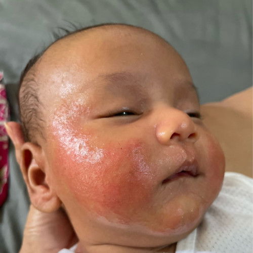 Kulit anak kering dan merah