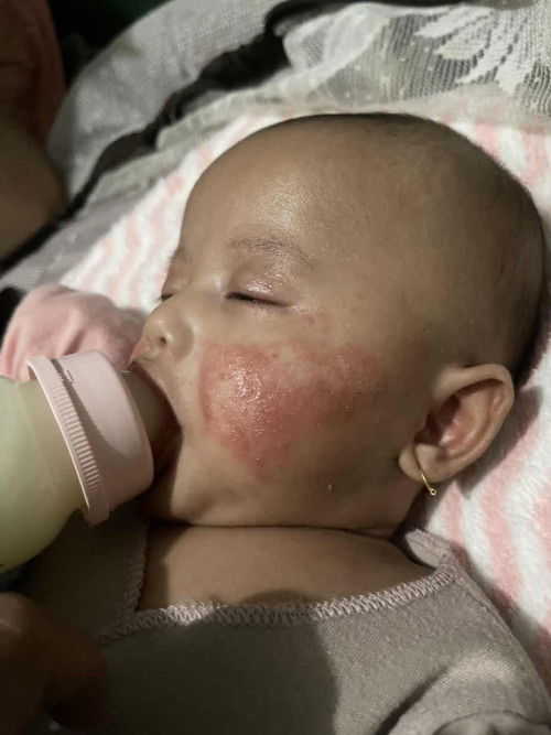 Ruam pipi  bayi