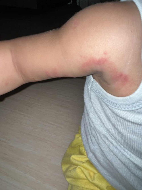 Merah di kulit bayi