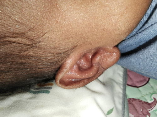 Telinga anak ruam dan ber air