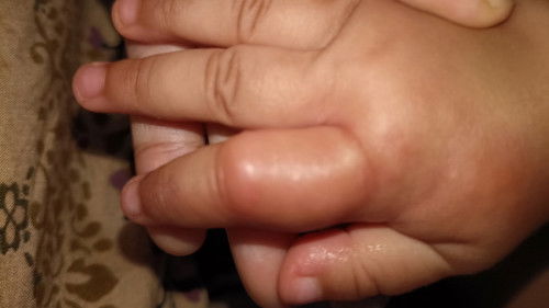 Bengkak pada jari telunjuk anak