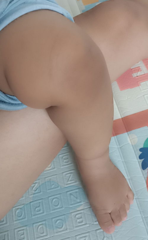 Lutut bayi menghitam semenjak merangkak.