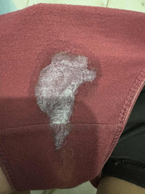 Vaginal discharge