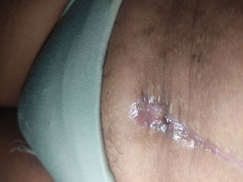 Normal lang po ba ito? 1month ago nung na cs ako niresetahan lang poko ng oilment