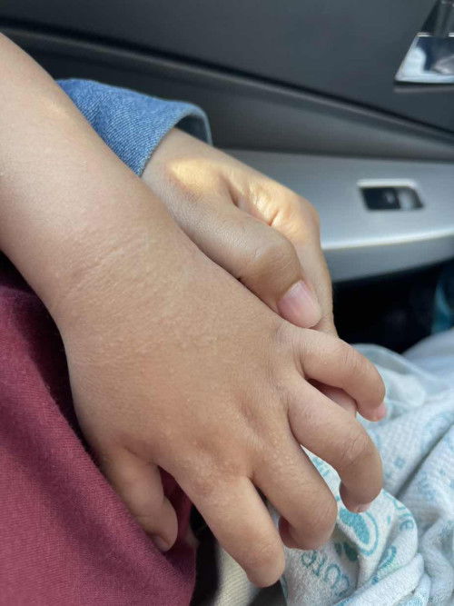 Adakah ini scabies