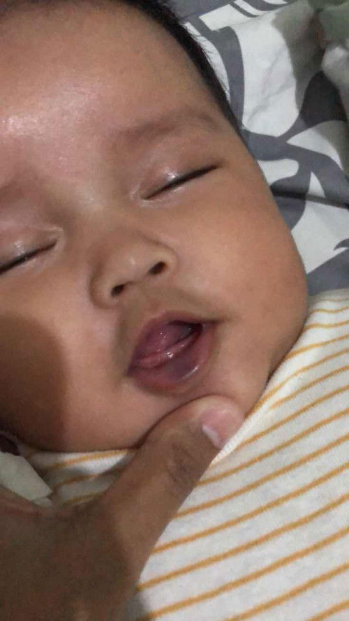 Bayi 5 Bulan suka menggigit bibir bawah sampai Biru