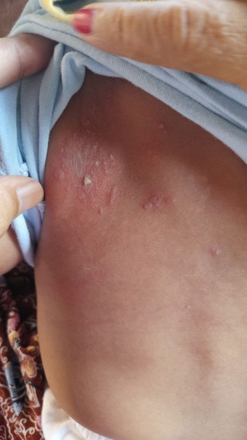Bunda2 adakah yang dedeknya mengalami herpes usia 3 bulan