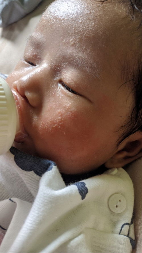 Cara mengatasi ruam merah kering di wajah bayi