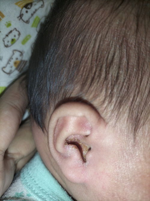 daun telinga bayi kering