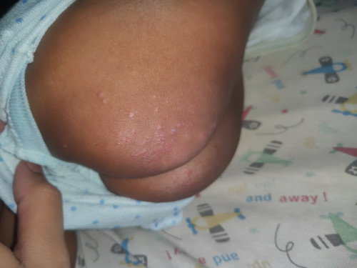 Ruam popok bayi 2 bulan perempuan