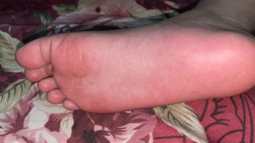 Telapak kaki merah