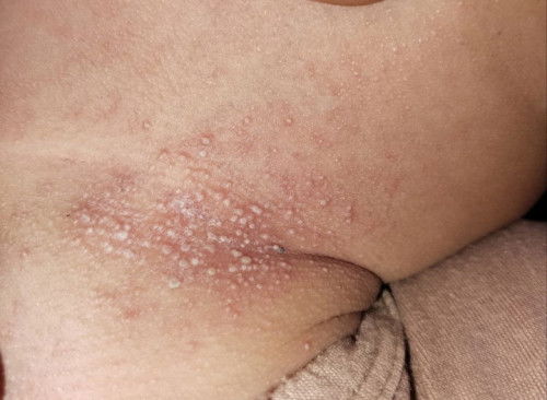 Bintik di leher anak