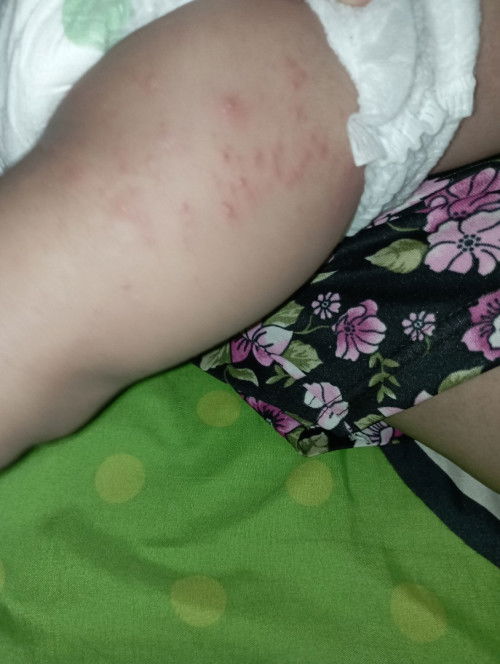 Apakah kaya gini ruam popok bund ?