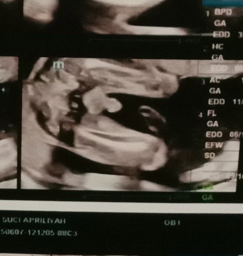 Jenis kelamin bayi
