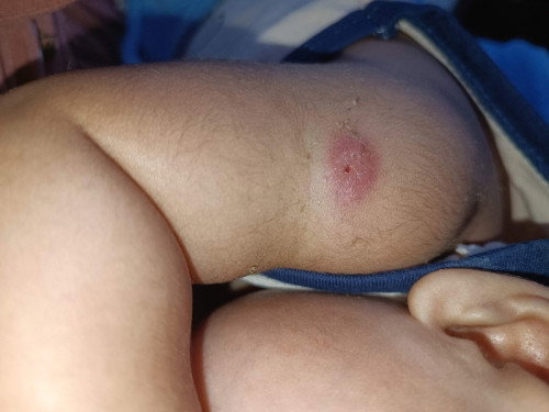 Bekas suntikan bcg anak saya kok bolong setelah bengkak dan bernanah, wajarkah bun?