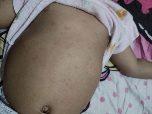 Bercak2 merah di badan bayi,